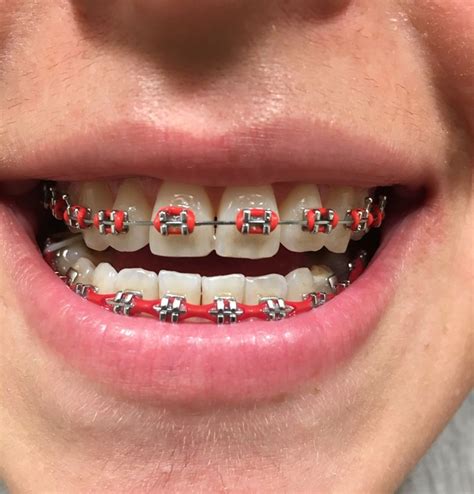 brace colors from actual orthodontist.